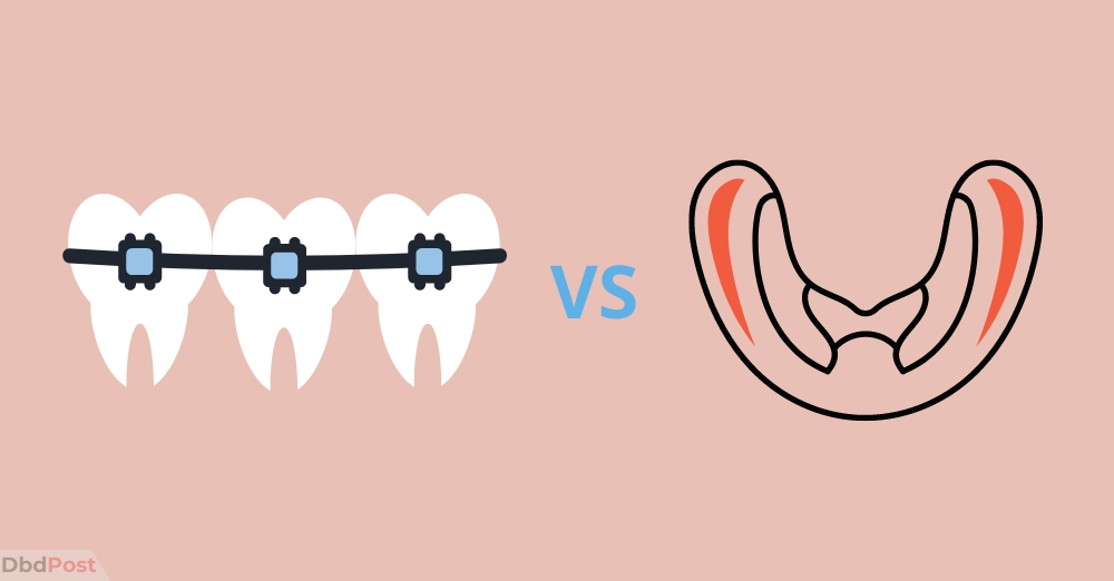 permanent retainer cost permanent vs removable