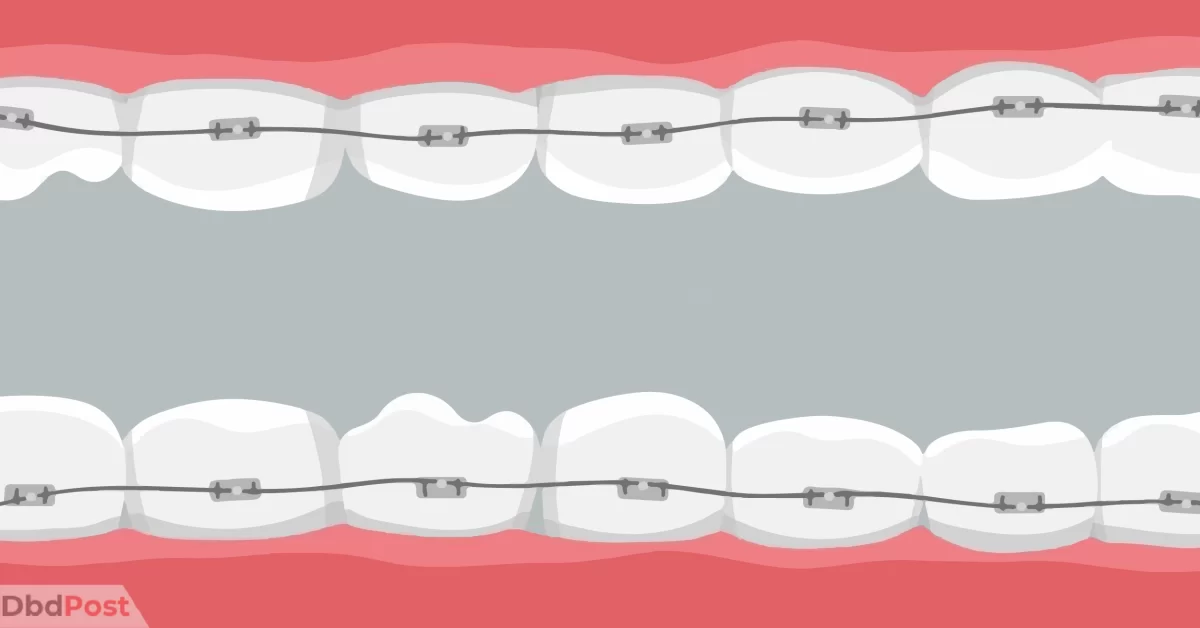 feature image-how much do braces cost-braces illustration-01