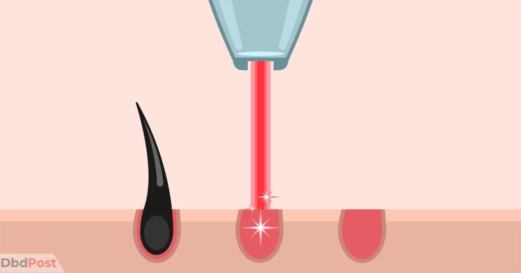 feature image-laser hair removal cost-laser hair removal illustration-01