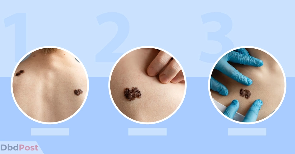 inarticle image-mole removal cost-Factors affecting mole removal cost-01