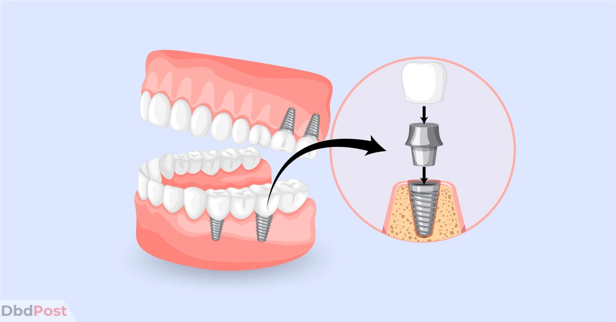 feature image-dental implant cost-dental implant illustration-01