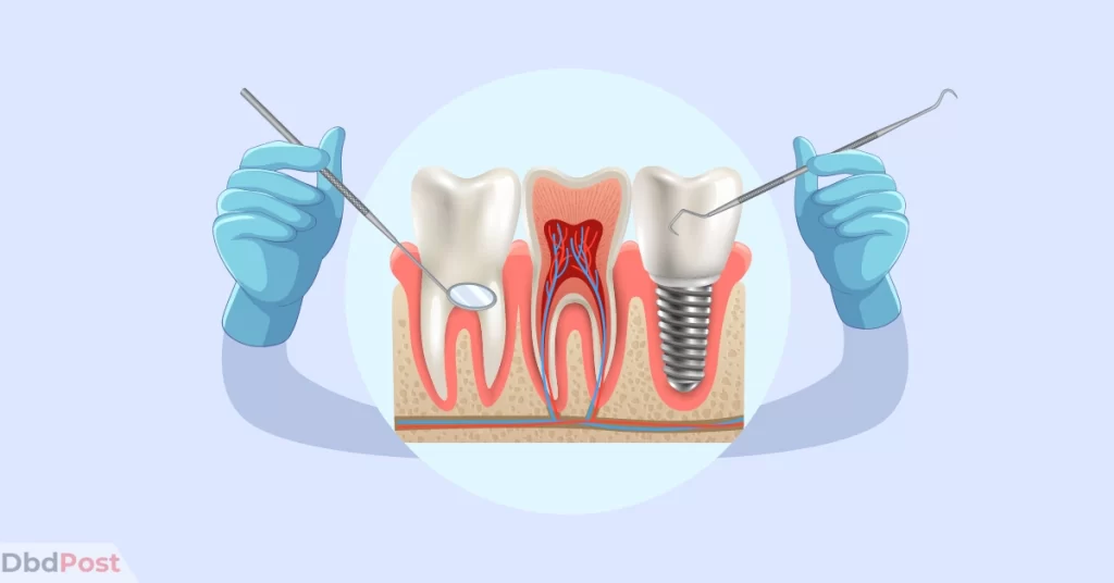 feature image-root canal cost-root canal illustration-01