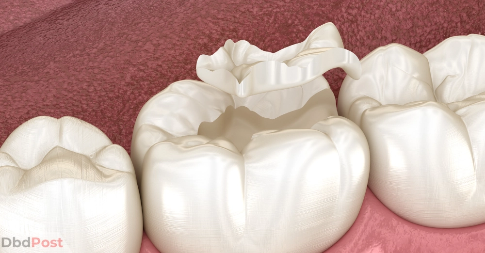 inarticle image-how much does it cost to fix a chipped tooth-Cracked tooth