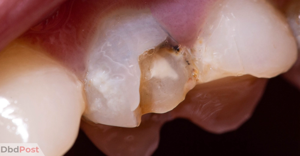 inarticle image-how much does it cost to fix a chipped tooth-Small chip