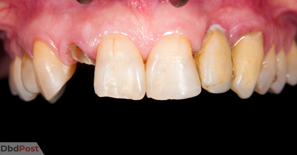 inarticle image-how much does it cost to fix a chipped tooth-Vertical root fractures