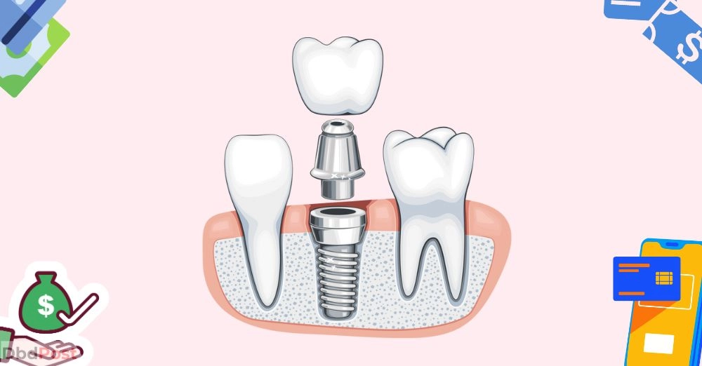 inarticle image-single tooth implant cost without insurance-Financing options for single tooth implants without insurance