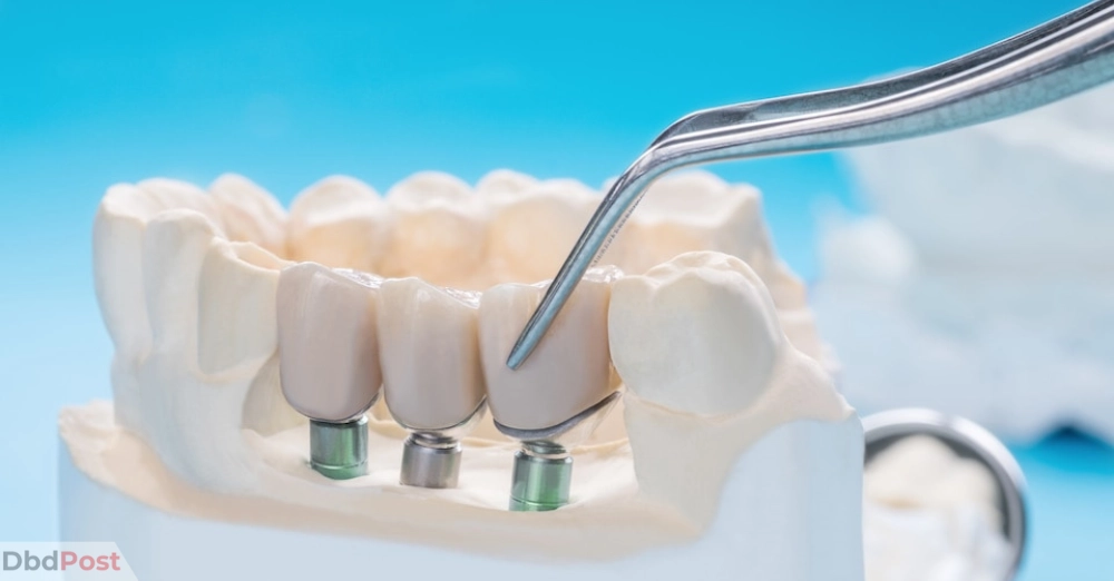 inarticle image-how much does a dental bridge cost without insurance-Types and cost of the dental bridge without insurance