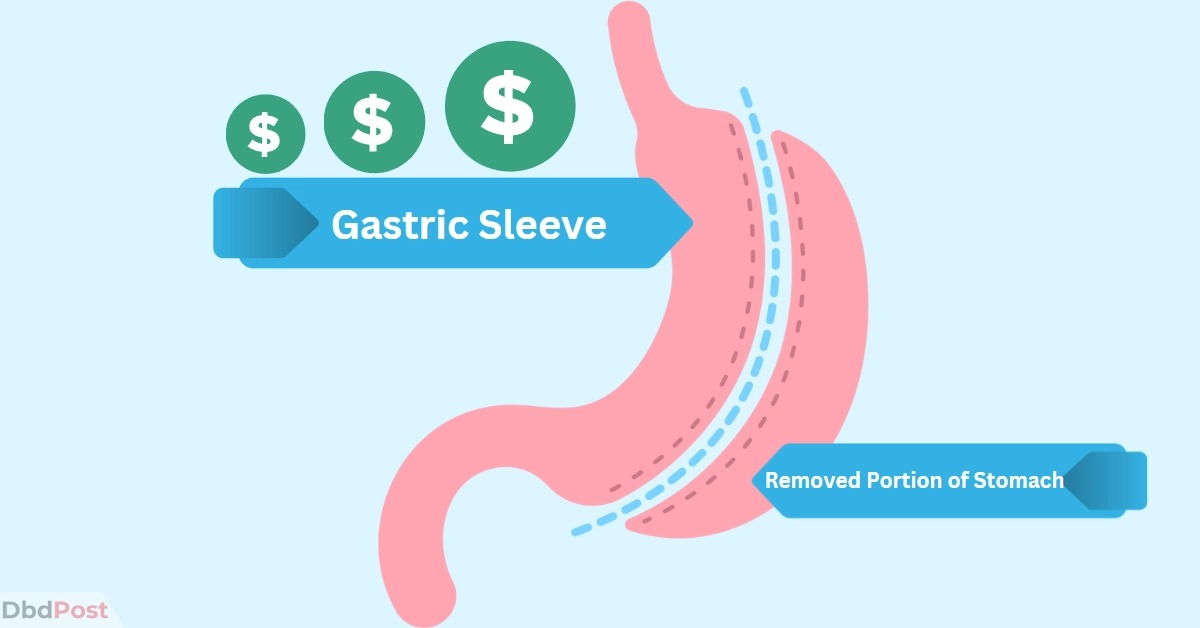 feature image-gastric sleeve cost-gastric sleeve cost illustration