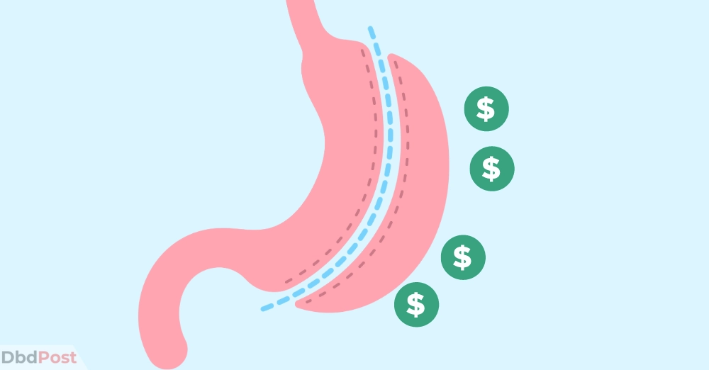 inarticle image gastric sleeve cost The cost of Gastric Sleeve in the US