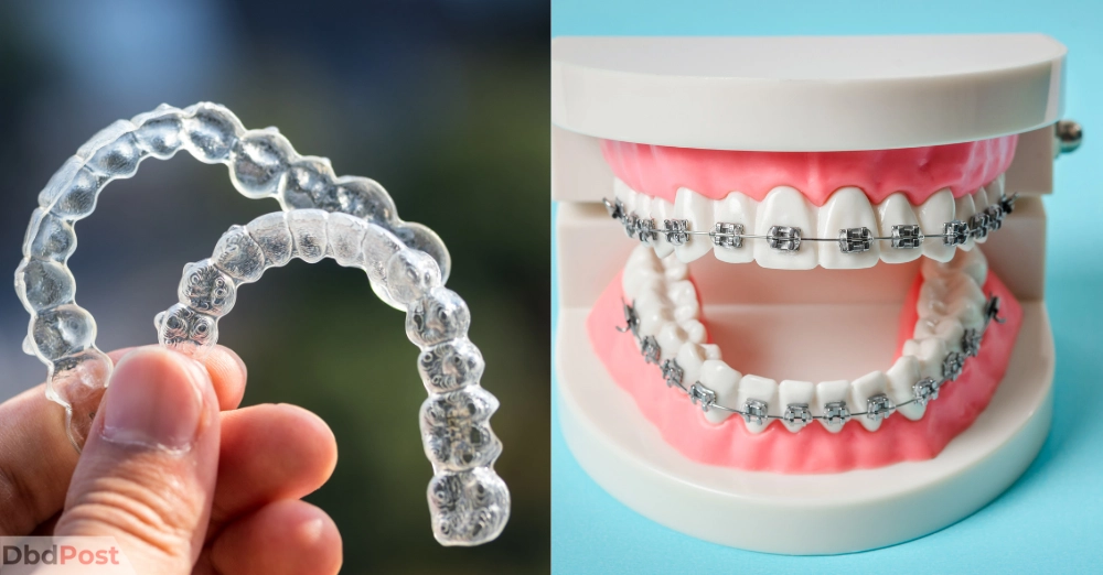 inarticle image-how much does invisalign cost-Cost of Invisalign vs. traditional braces
